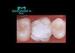 Composite Dental Veneers good to restore small damage of tooth surface