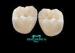 High Noble Palladium-Silver Composite Dental Veneers without discoloration