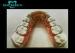 Spring Splint Material Different Orthodontic Appliances Difficult to Clean