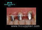Dental PFM Crown White Gold Dental Post and Core in Dentistry