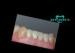 Gold composite Captek Naogold crowns restoration better gingival health