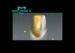 Gold composite Captek Nanogold Crowns Restoration Porcelain bonder