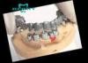 Telescopic Crowns Attachments for Implant Supported Restorations