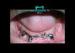 Improve Bitting Force Implant O-Ring Attachment For Tooth Supported Mandibular Overdenture