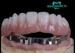 High Retention Bar Attachment Metal Based Dentures For Comestic Defects Implants