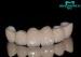 Durable All Ceramic Dental Crown Germany Sirona Cerec None Preciouse PFM