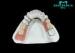 Distinguished Precision Denture Cast Partial Framework Titanium Material Easy Clean