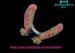 Keyway Preci-Line Precision Partial Denture Attachments Restore Missing Teeth'S Fuction