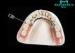 Lock Dental Attachments Dentures Teeth With Strong Corrosion Resistance