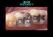 Distinguished Biocompatible Tough Palladium-Silver Alloy Porcelain Inlays And Onlays
