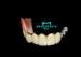 Precision Attachment Telescopic overdenture Yellow Gold Material