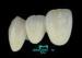 Precious Ultra-hard High Noble White Gold types of Dental Implant Crown
