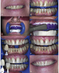 Dentlasertip whitening handpieces bleaching handpieces