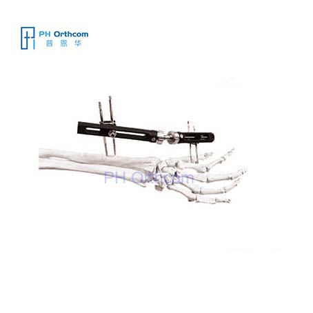 Penning Wrist Fixator(PEEK) for Distal Radius Fragment Orthofix Types External Fixation System