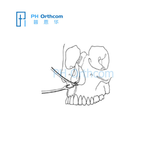 Instrumento para la cirugía cráneo-maxilofacial instrumento ortopédico Tabique Nasal osteótomos