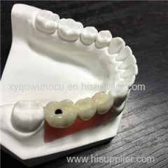 Implant Crown And Bridge