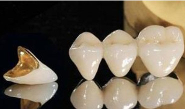 porcelain fused to mental teeth