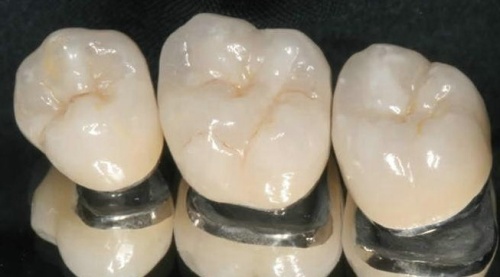 high biocompatibility porcelain fused to mental crown