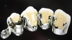 implant porcelain teeth dental porcelain