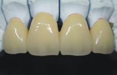 Alloy Ceramic teeth Ceramic denture