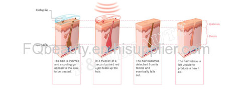 OPT / SHR best pulse fast hair removal machine, easy to operate