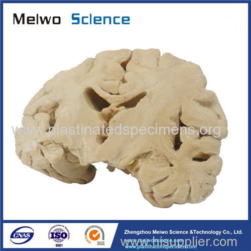 Coronal section of brain plastinated specimen