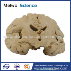 Coronal section of brain plastinated specimen