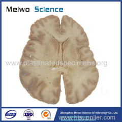 Horizontal section of brain through inner capsule plastinated specimen