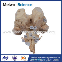 Brain stem plastination specimen with complete nerve root