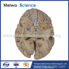 Tractus opticus and optic radiation plastinated specimen