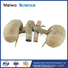 Double kidney plastination specimen for sale