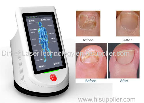 Best Nail Fungus Laser Machine to Kill Toenail Fungus