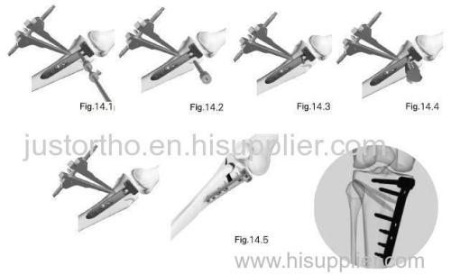 Periarticular Locking Plate System Material: Ti