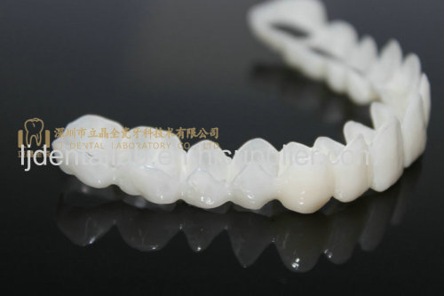 CAD/CAM resin Dental clip on veneers