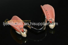 Dental attachment & TK1 & MK1 & precision attachment & dental denture & slot attachment