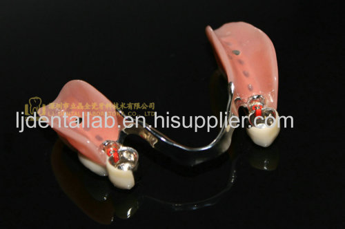 Dental attachment & TK1 & MK1 & precision attachment & dental denture & slot attachment