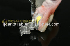 Dental precision attachment & dental attachment & dental denture & laboratoire dentaire