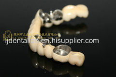 Telesopic crown & Dental telescope denture & dental prosthesis