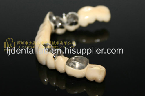 Telesopic crown & Dental telescope denture & dental prosthesis