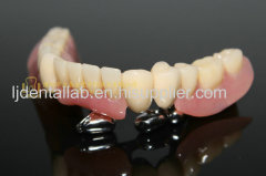 Dental telescope denture & telesopic crown & dental prosthesis