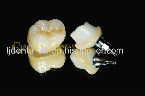 Dental implant abutment & implant crown & implant prosthesis & Intergrate Abutment Crown