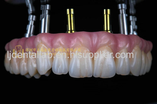 Dental implant prosthesis & implant denture & dental prosthesis