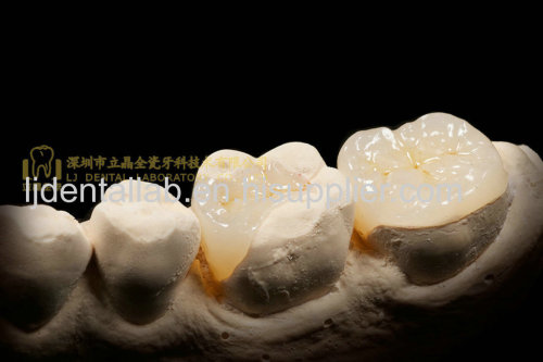 Dental crown e.Max ceramic & porcelain crown & dental veneers