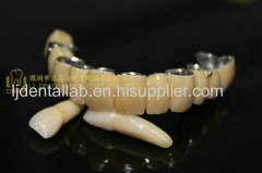 Dental crown composite & dental teeth & Shofu Ceramage dental prosthesis