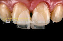 Ultra-thin dental veneers & porcelain veneer & dental laminates