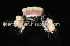 Dental Co-Cr partial denture & Titanium framework denture & dental partial dentures & full dentures