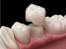 Dental Treatment Dental Metal Ceramic Crown Made Dental Lab in