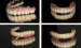 Dental Treatment Dental Metal Ceramic Crown Mad
