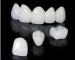 Dental Crown Porcelain Fused Metal PFM Dental Prothesis Laboratoire Dentaire Dentallabor Dental Lab