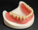 Denture Attachment 3D Metal Printed